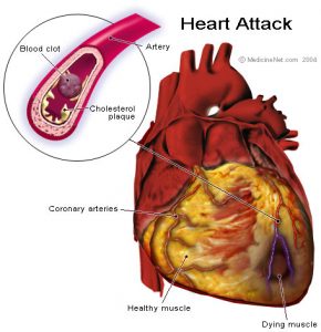 heart_attack-290x300.jpg